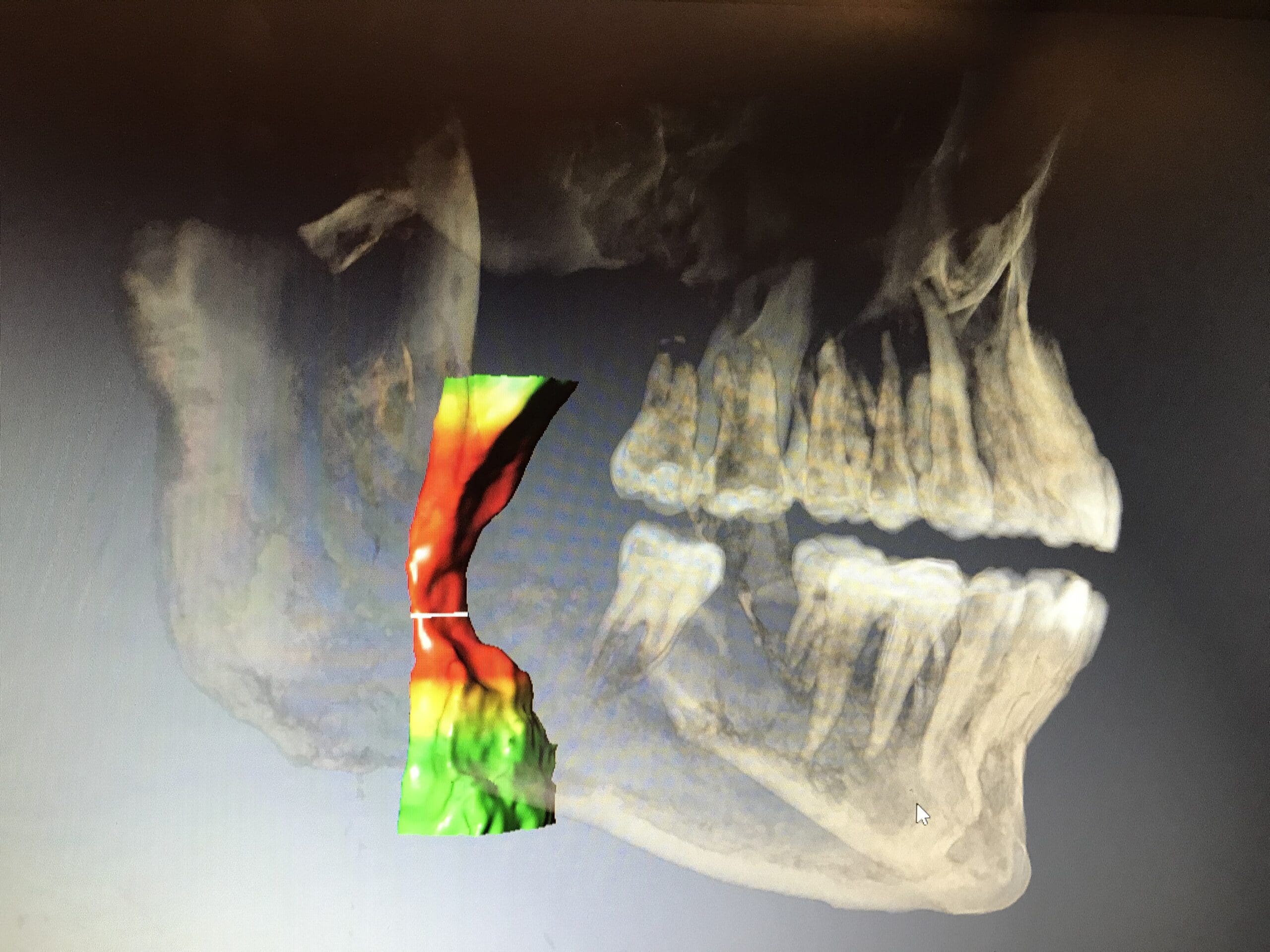 Obstructive Sleep Apnea