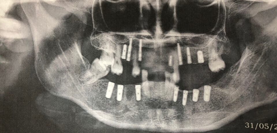 CBCT