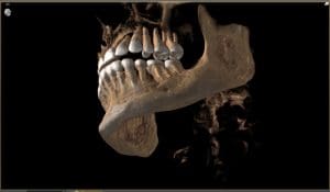 Dental Implant