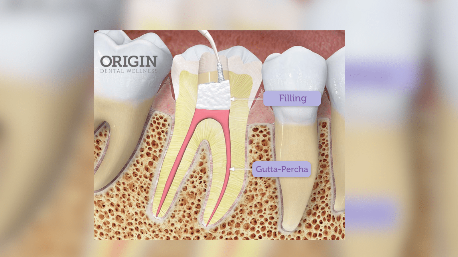 What’s Inside a Root Canal and Why It Can Be So Deadly