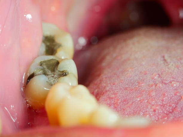 A detailed view of human molars featuring dental fillings and adjacent gums, highlighting the attentive care typical of a biological, health-centered dentist at Origin Dental Wellness in Tulsa, Oklahoma.